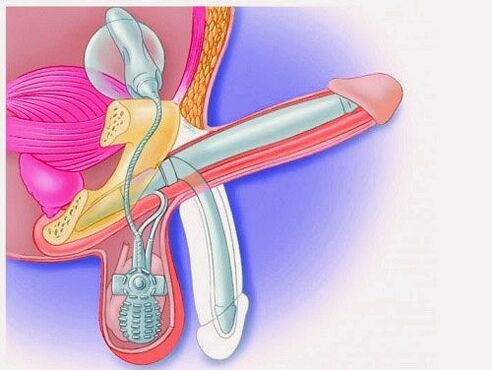 Méadú bod ag próistéise penile